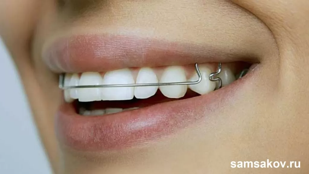 Взрослым зубные пластины нужны для поддержания результата после ношения брекетов