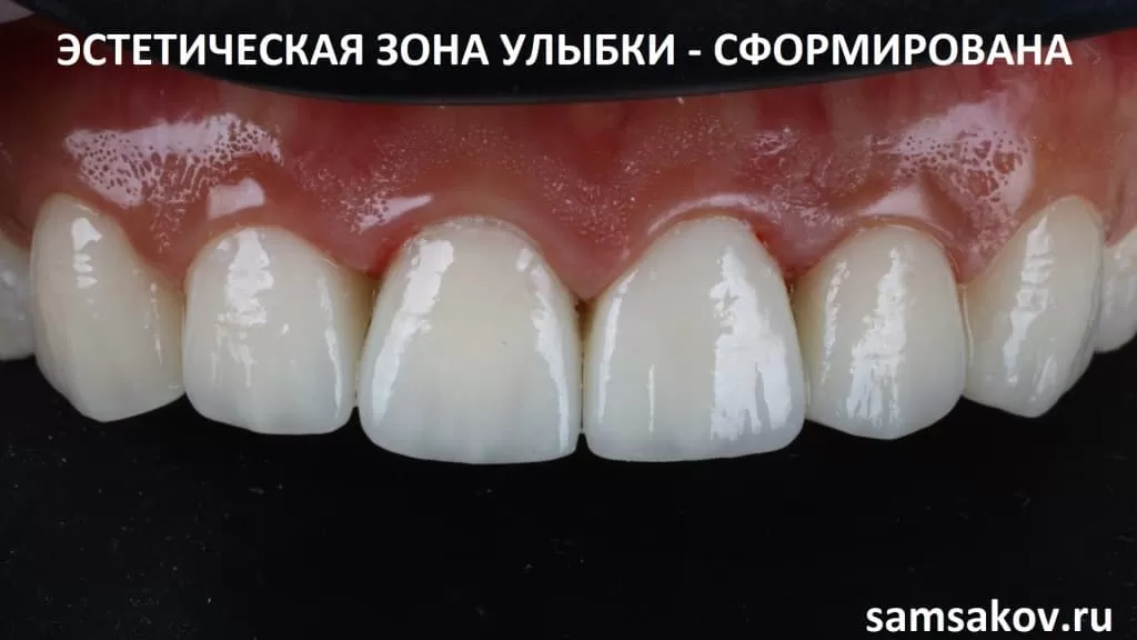 Восстановленный верхний ряд передних зубов