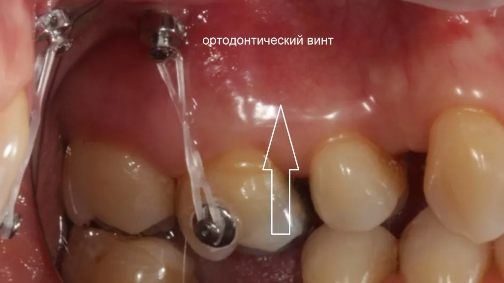 Интрузия моляра с помощью ортодонтического винта миниимпланта и специальной резиновой тяги