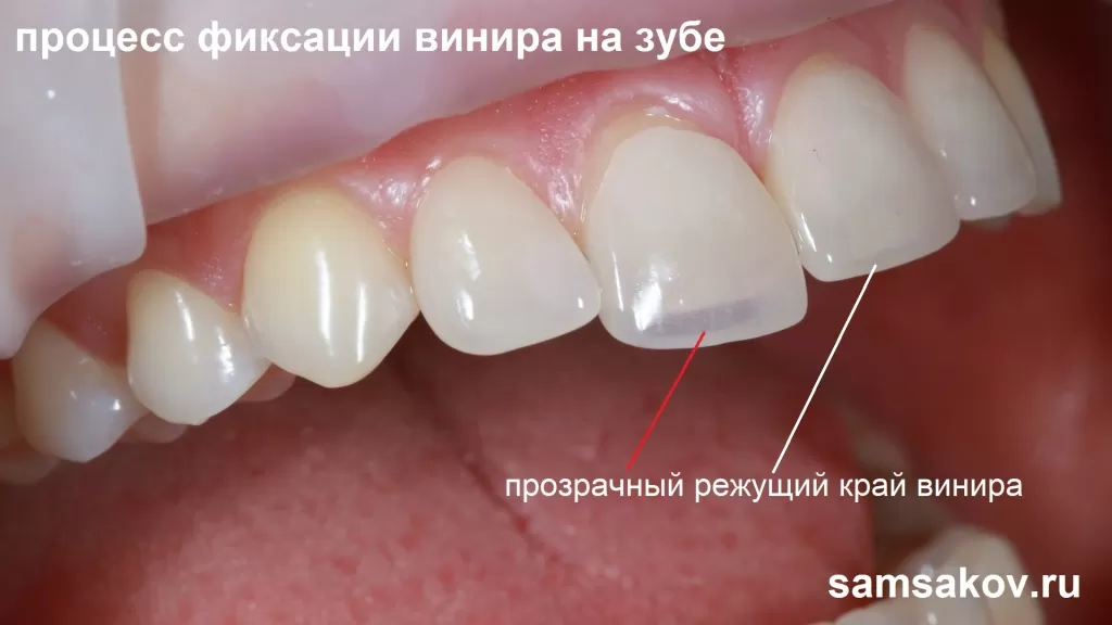 Высочайшую эстетику зубам придает и прозрачный режущий край винира