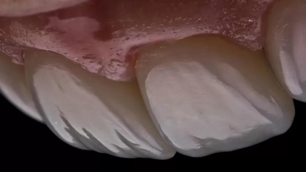 Пародонт - это комплекс тканей, которые окружают зуб, это десна, которую мы видим, костная ткань, которая находится под десной и связка зуба, которая окружает наш зуб.