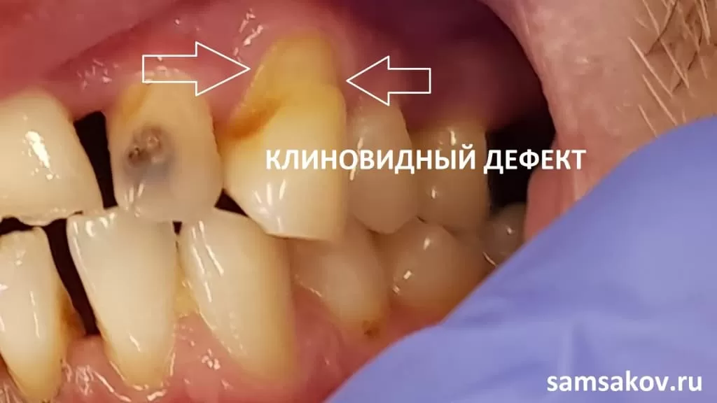 Клиновидный дефект, по-сути, это просто отсутствие части зуба. Ортопед Сергей Самсаков, Москва