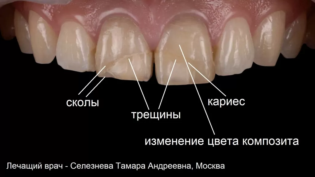 Композитные реставрации , особенно на передних зубах, очень недолговечны и часто разрушаются.