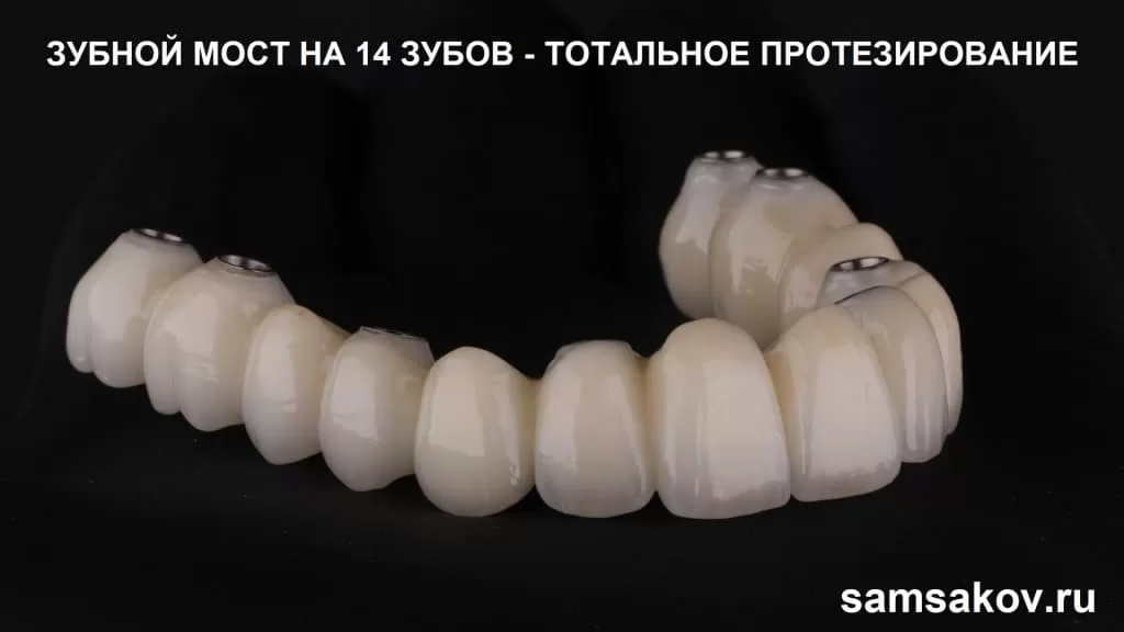 Тотальный зубной мост на 14 зубов для установки на импланты