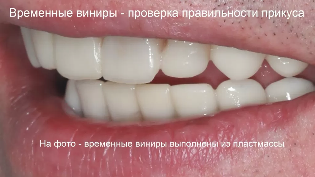 Временные виниры кроме проверки на кросоту будущих зубов проверяют еще и прикус пациента