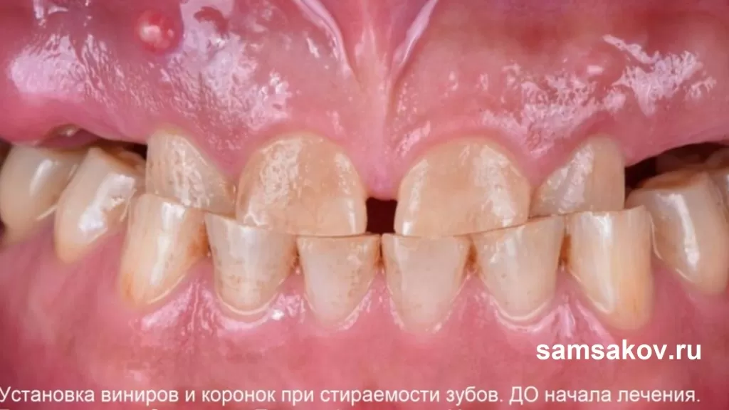 Как быстро остановить стираемость зубов. Бьюти ортопед Самсаков Сергей Сергеевич, Москва