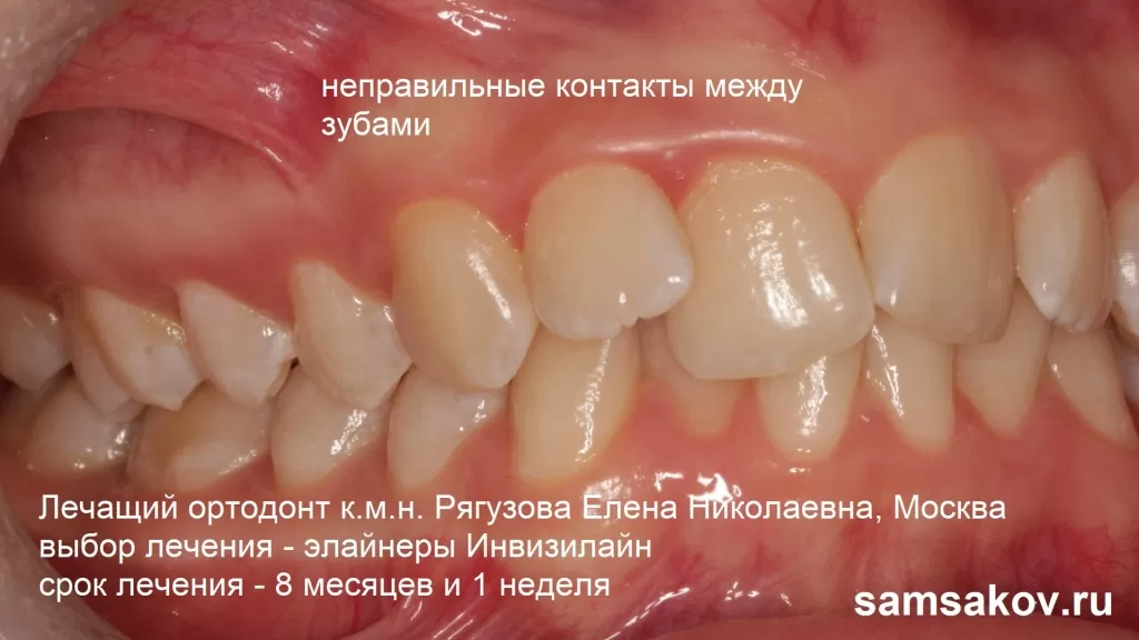 Фото неправильные контакты с соседними зубами. Лечащий ортодонт к.м.н. Рягузова Елена Николаевна, Москва