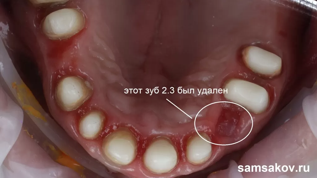 Вид восстановленных циркониевыми вкладками зубов