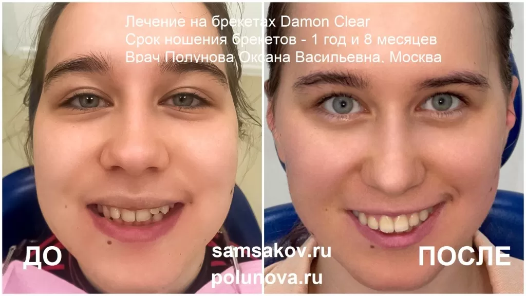 Лечение протрузии на брекетах Damon Clear. Фото до и после.