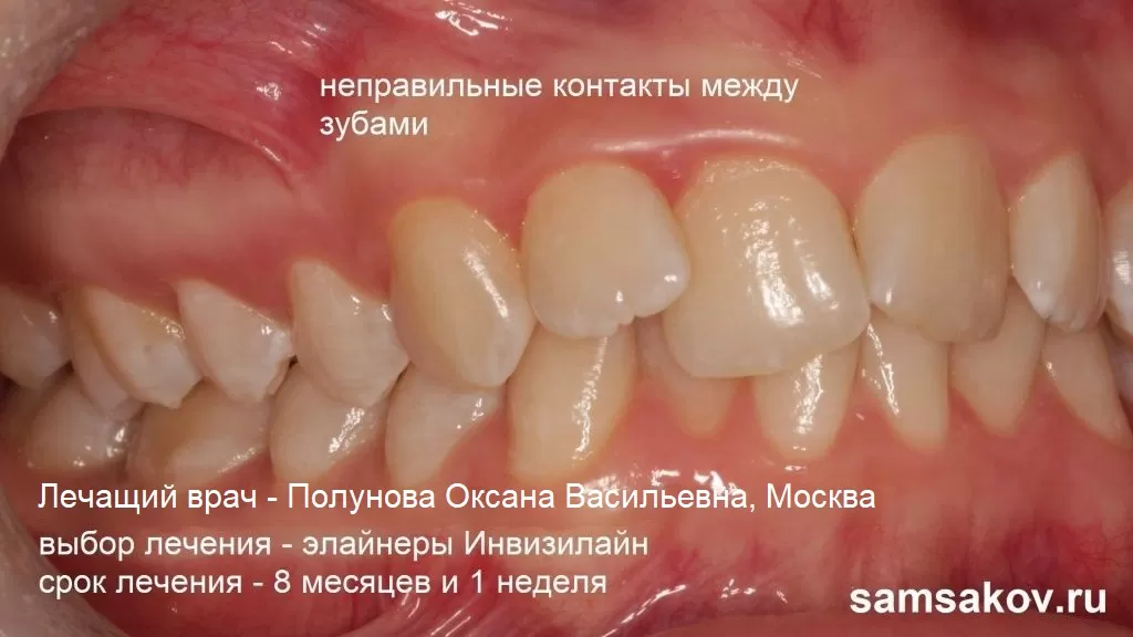 Фото неправильные контакты с соседними зубами. Лечащий ортодонт Полунова Оксана Васильевна, Москва