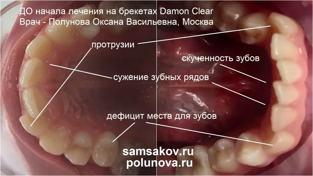 Лечение протрузии и скученности зубов брекетами Damon Clear. Вид до начала исправления прикуса