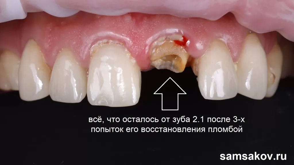 Фото отсутствующего зуба 2.1 в результате трех неудачных попыток его восстановления световыми пломбами