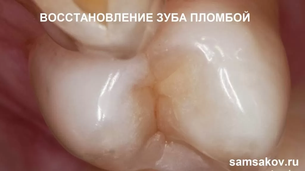 Восстановление зуба пломбой. Реставрация зуба