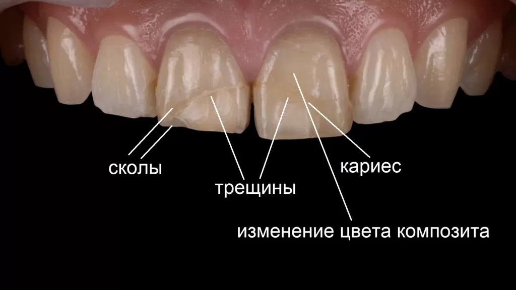 Композитные реставрации , особенно на передних зубах, очень недолговечны и часто разрушаются.