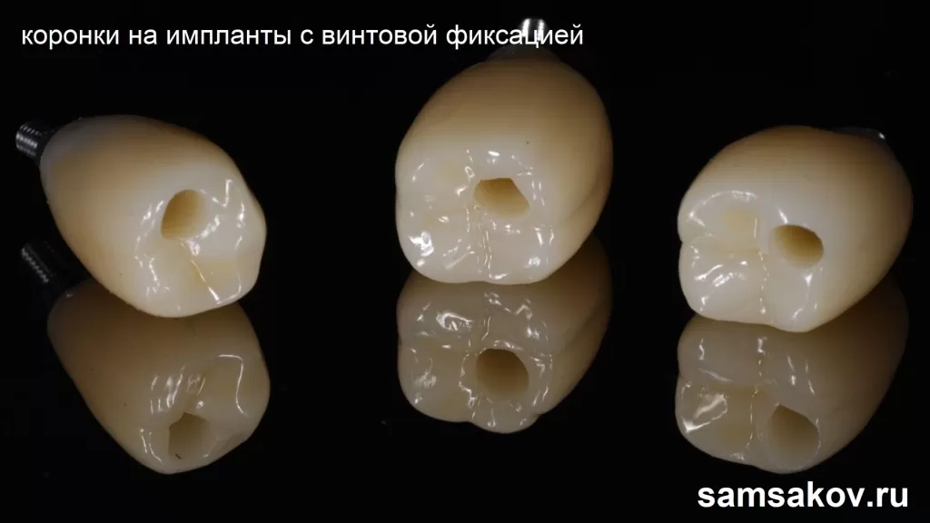Коронки на импланты для жевательной группы зубов