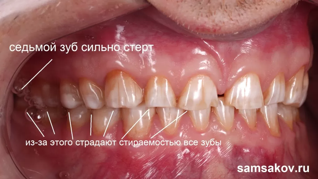 Последствия такой опасной проблемы, как стираемость седьмых зубов - стираемость всех зубов