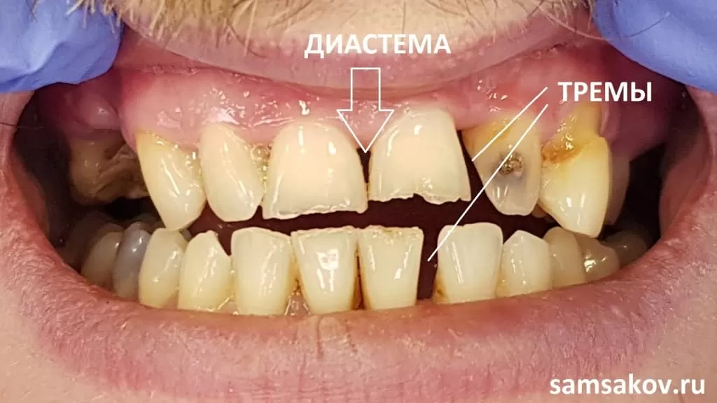 На нижних и верхних зубах были тремы и диастема – щели между зубами. Лечащий врач - Самсаков Сергей, Москва