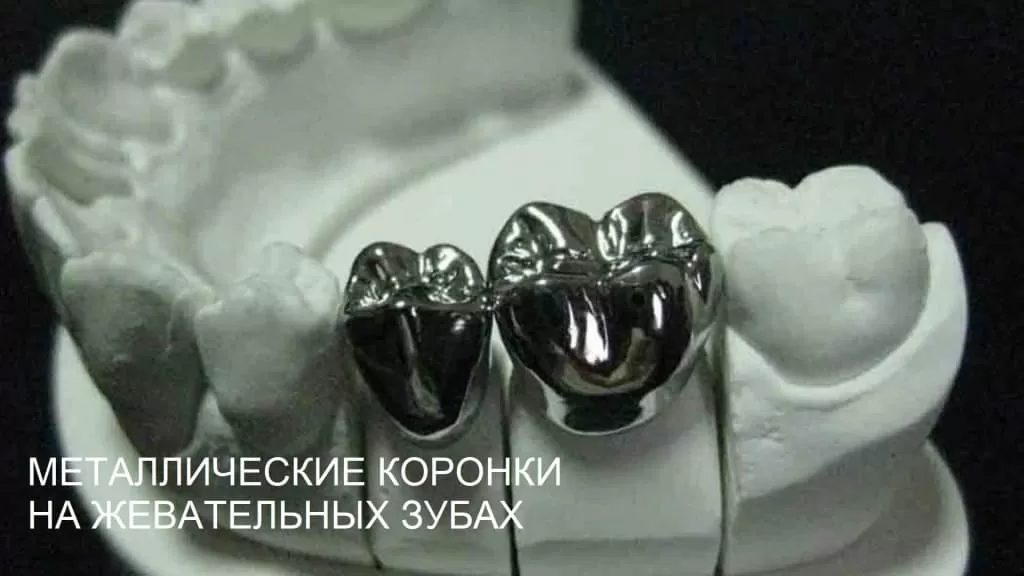 Металлические коронки на жевательные зубы