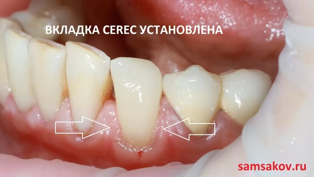 Владка cerec на нижний клык установлена. Автор - стоматолог Сергей Самсаков, клиника Cerecon, Москва