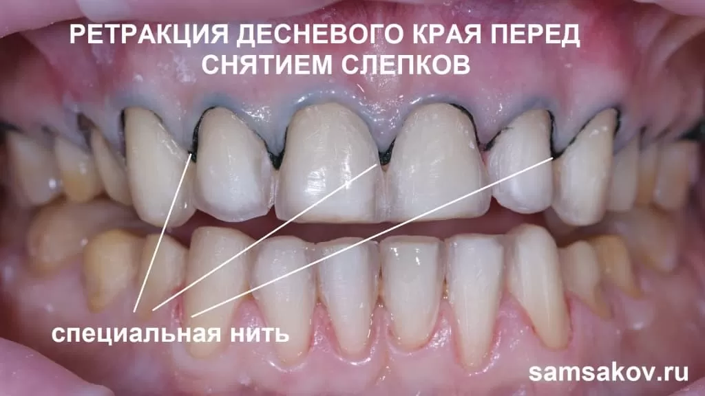 Фото ретракции десен зубов перед снятием слепков для установки виниров