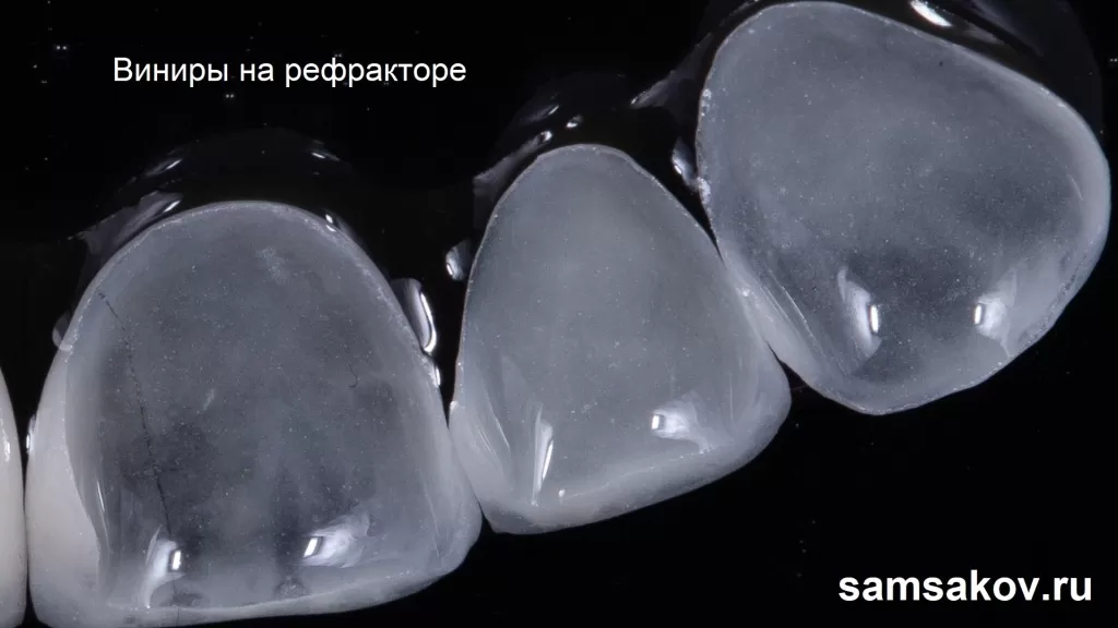 Виниры на рефракторе - прозрачная эстетика зуба