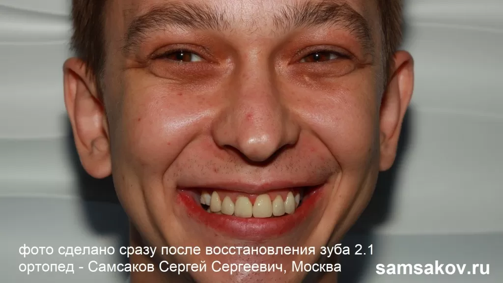 Первая улыбка Дмитрия после установки модуля CEREC в область зуба 2.1