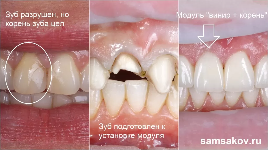 правый верхний зуб 1.1 был депульпирован, на нем присутствовала пломба почти в половину зуба и его пришлось сделать как штифтовый зуб