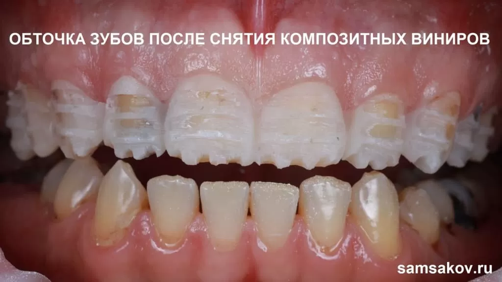 Обточка зубов после снятия композитных виниров