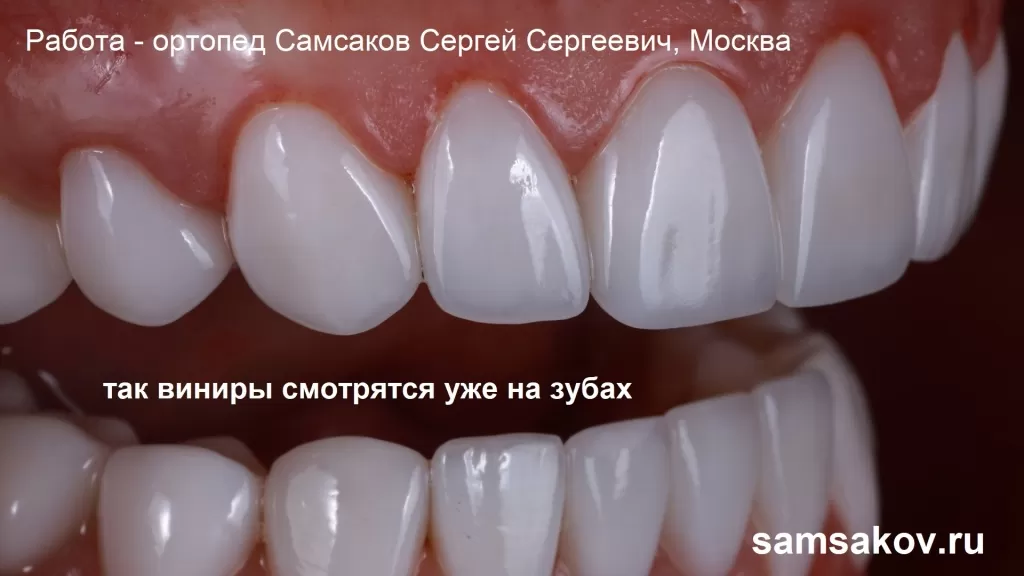 Так смотрятся покрывные виниры на зубах. Лечащий врач - Самсаков Сергей Сергеевич, Москва