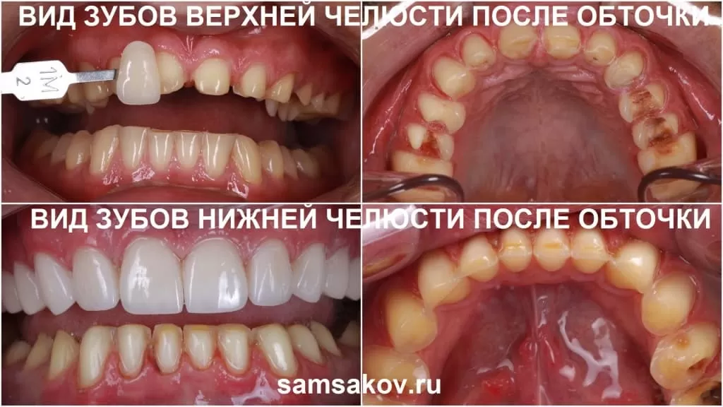 Фотоколлаж зубов после препарирования под виниры