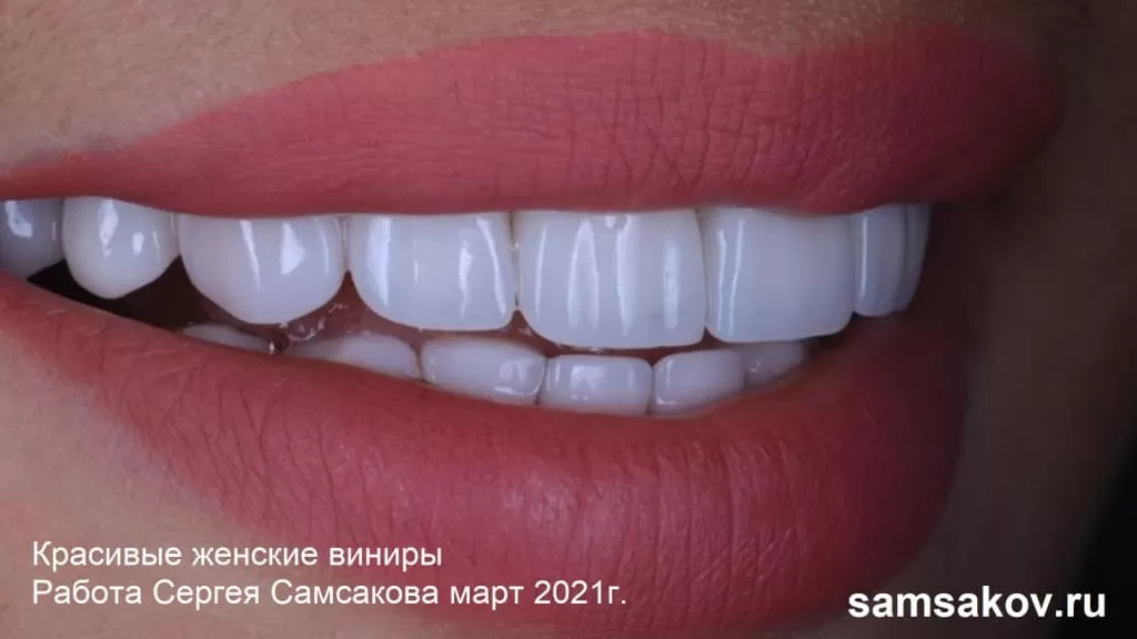 Красивые виниры для женщин - ортопед Сергей Самсаков, Москва