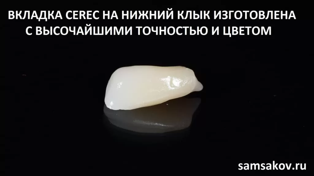 Вкладка cerec на нижний клык. Автор - Сергей Самсаков, ортопед стоматологического центра CERECON, Москва