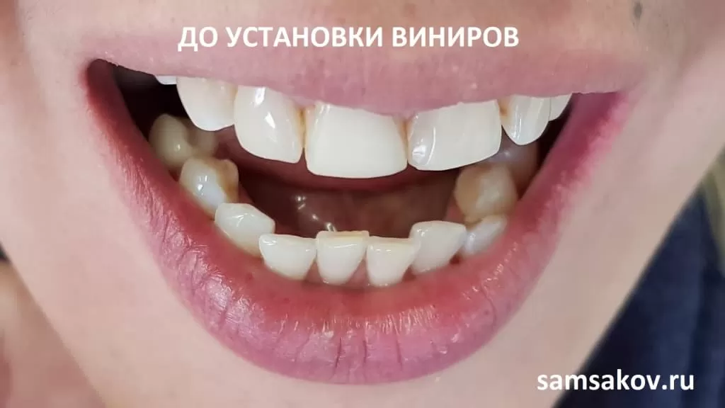 Вид зубов на момент обращения до установки виниров. Лечащий доктор - ортопед Сергей Самсаков, клиника Cerecon, Москва