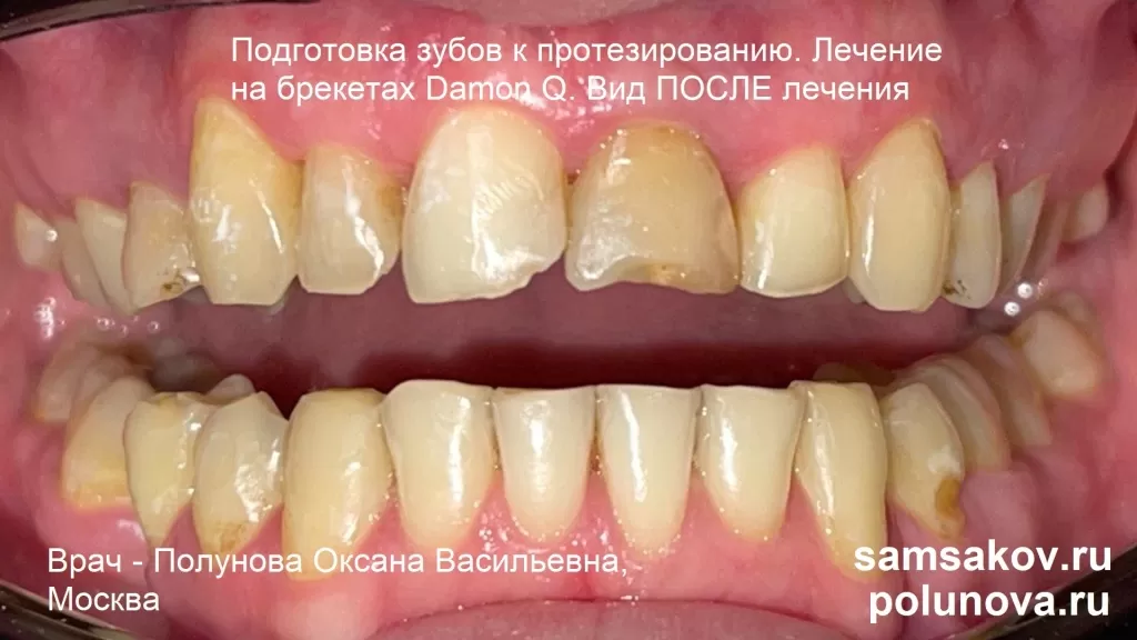 Подготовка зубов к установке импланта, коронок и виниров с помощью брекетов Damon Q