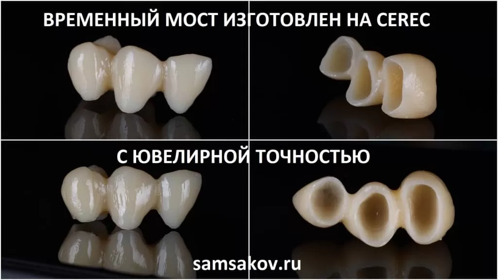 зубной мост