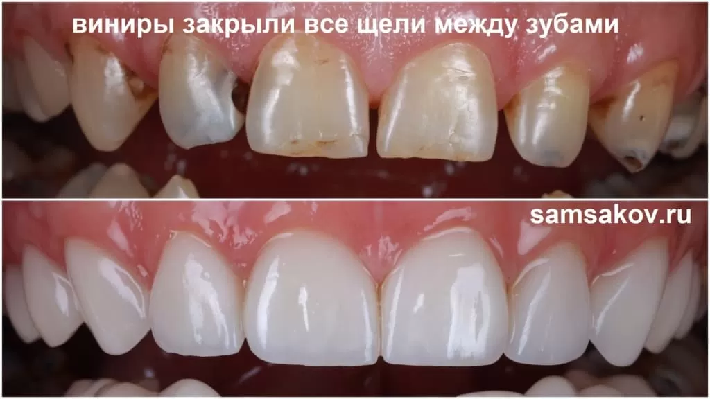 Фото ширины верхних зубов до и после установки виниров.