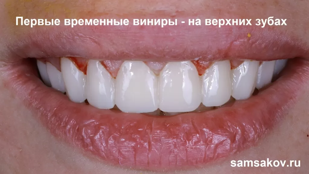 Фото Дарьи с временными винирами - очень красивая форма зубов получилась. Ортопед - Сергей Самсаков, Москва