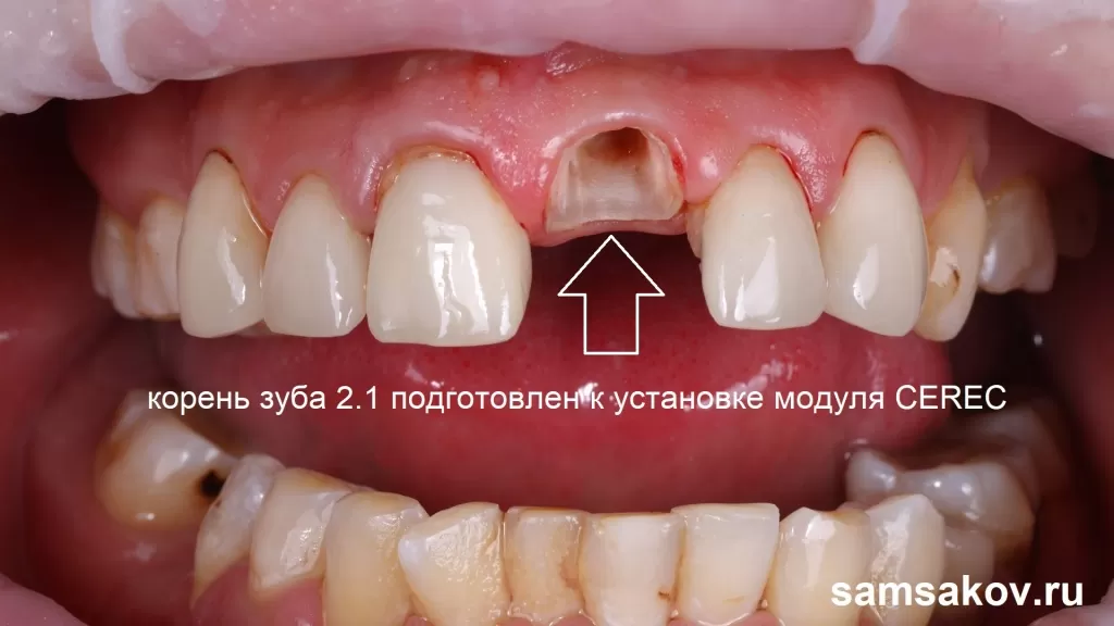 Корень зуба очищен от отожений