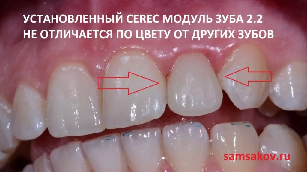 Реставрация верхнего резца 2.2 по технологии Церек провел ортопед Сергей Самсаков, клиника Церекон, Москва.