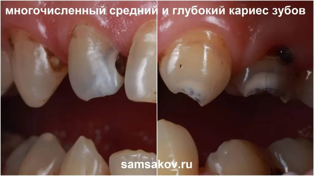 Фото - глубокий и средний кариес зубов