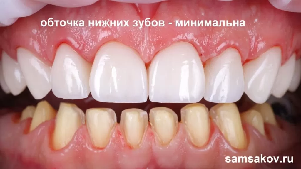 Фото - минимальная обточка нижних зубов для установки виниров