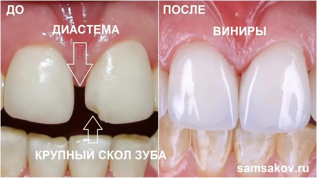 Как убрать диастему между зубами и сколы винирами - рассказывает ведущий ортопед клиники Cerecon Сергей Самсаков