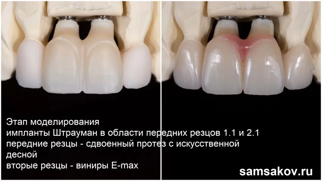 Протез с десной позволил сделать передние зубы максимально естественными
