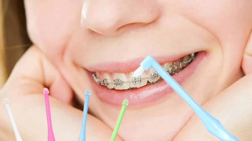Монопучковая зубная щетка помогает очистить пространства вокруг брекетов