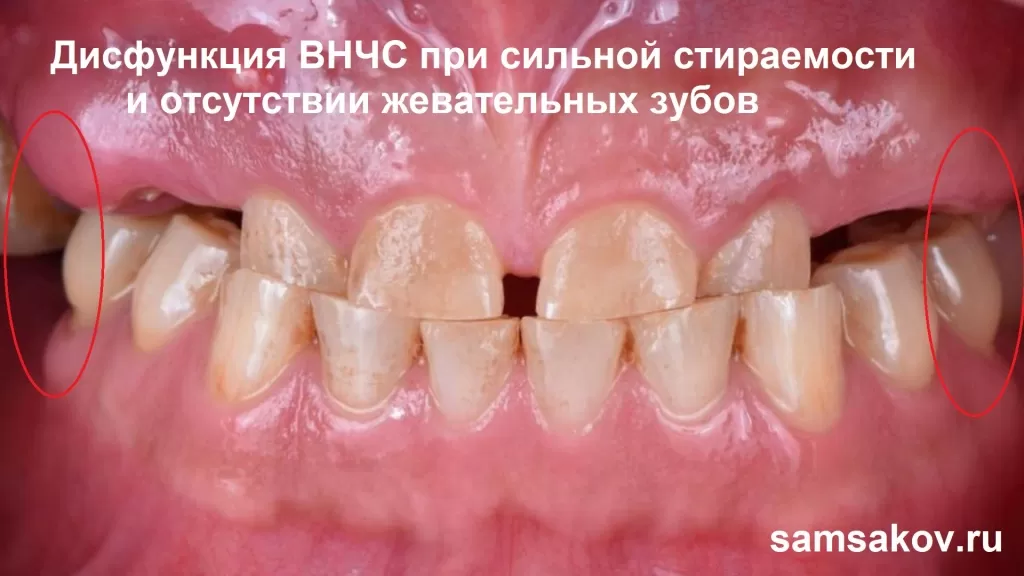 Классический пример дисфункции ВНЧС при стираемости и разрущении жевательной группы зубов