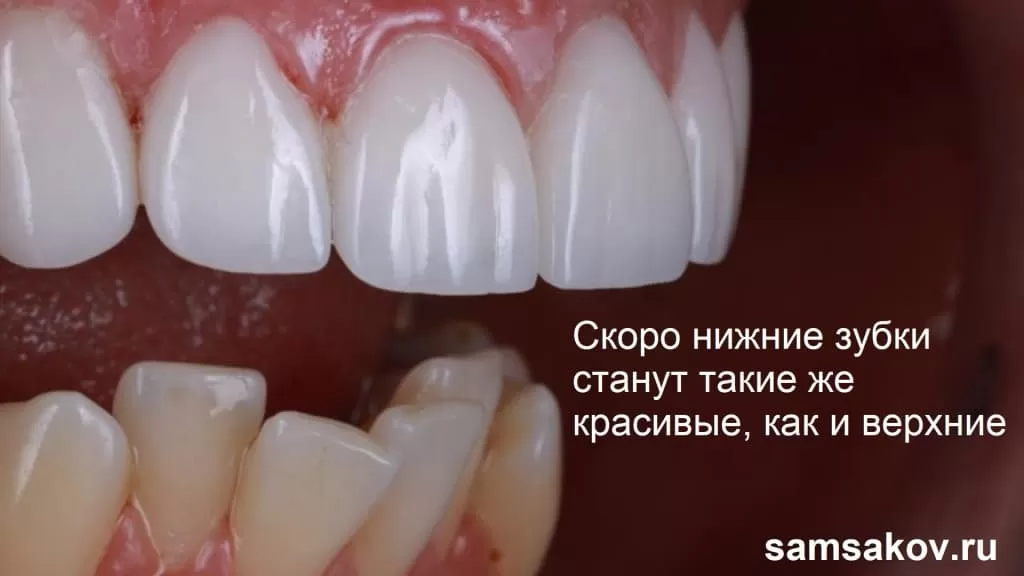 Виниры отлично убирают дефект кривых зубов