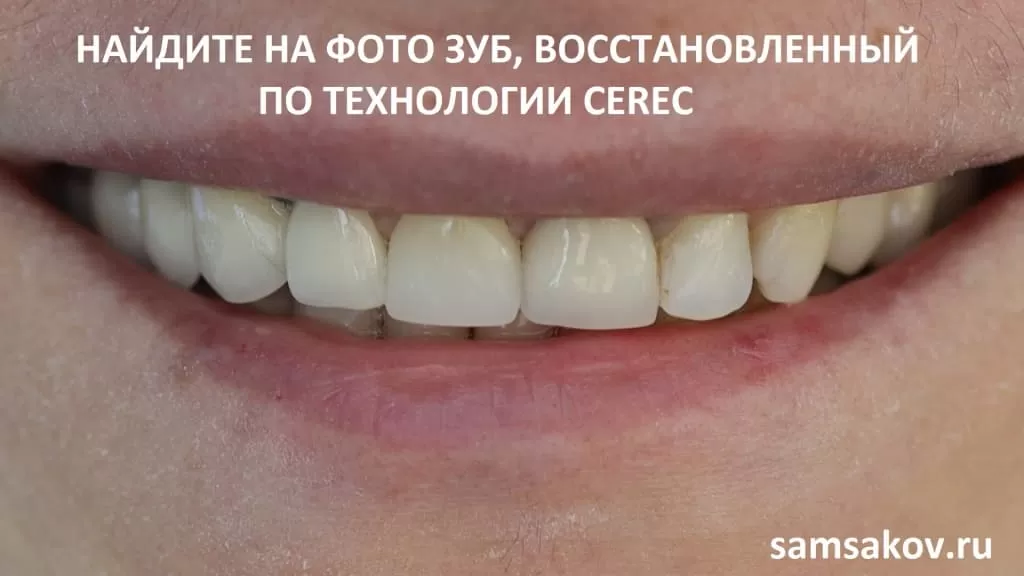 Восстановление зуба из корня