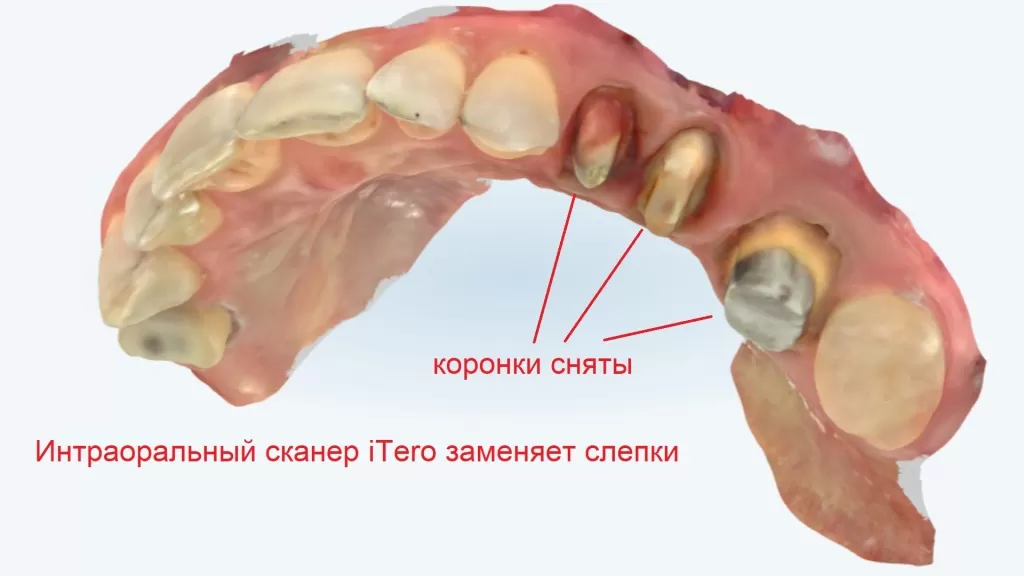 Сканирование культи жевательного зуба после снятия коронок. Не используем гипсовые слепки