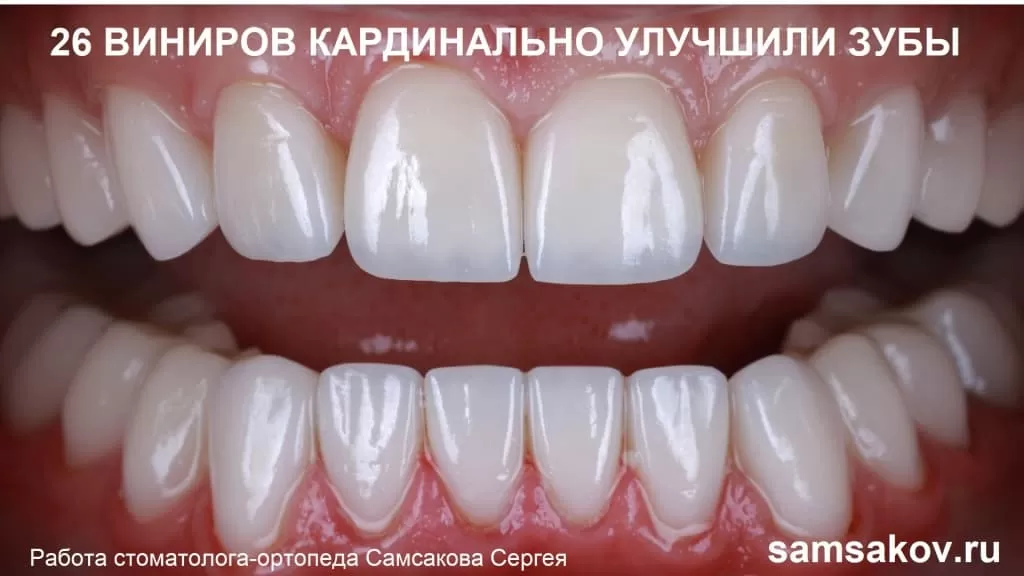 Установка 26 виниров мужчине в возрасте 30 лет. Работа стоматолога-ортопеда клиники Церекон - Самсакова Сергея