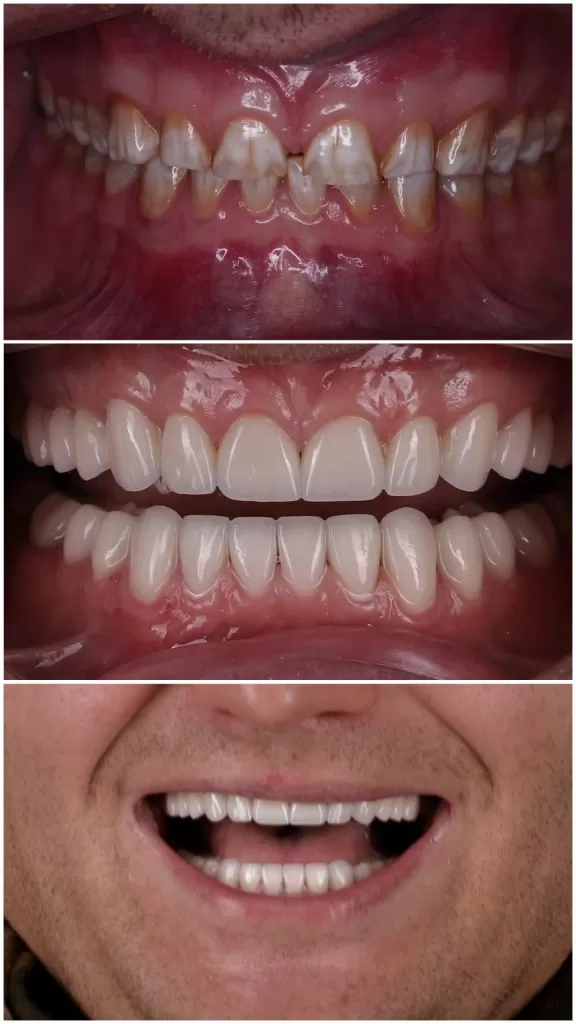 Тотальное протезирование при стираемости зубов и флюорозе